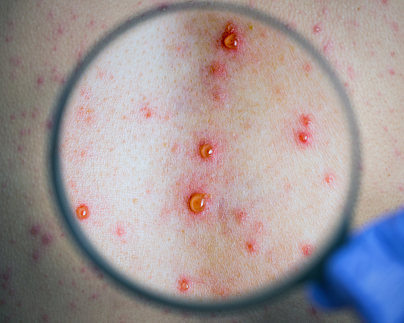 Ветрянка у детей: как выглядит и чем лечить