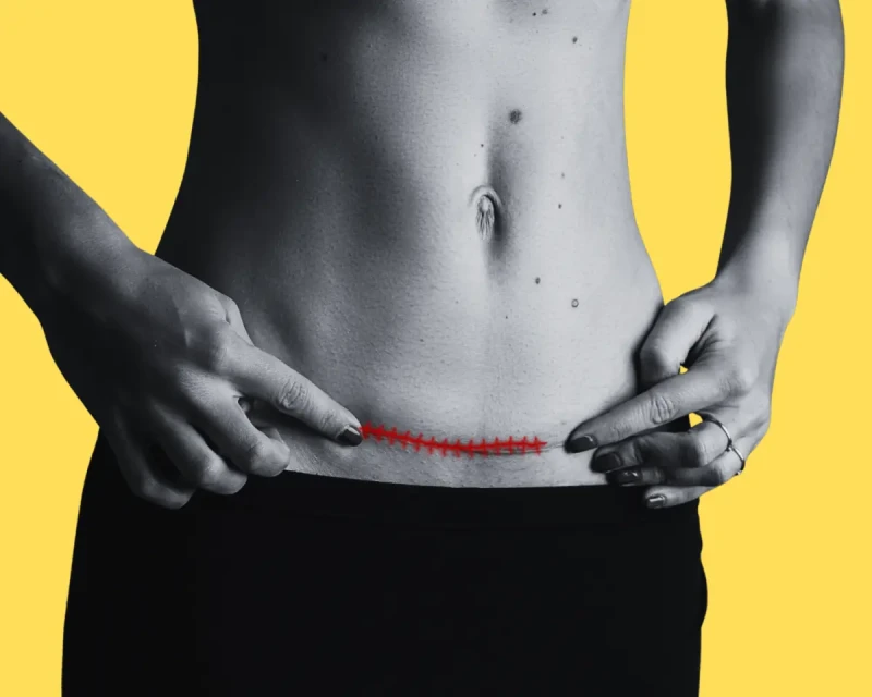 Восстановление после кесарева сечения: бережный уход за собой