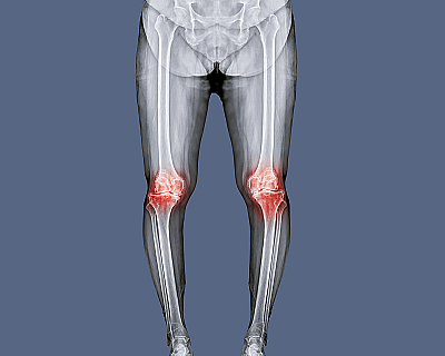 Рахит у детей