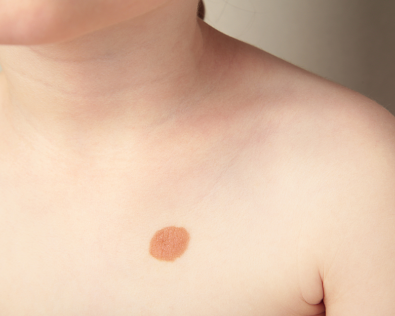 Родимые пятна у детей: виды, причины появления, диагностика и уход