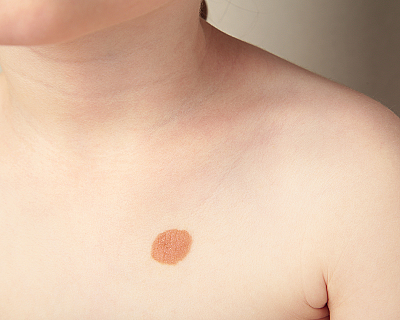 Родимые пятна у детей: виды, причины появления, диагностика и уход