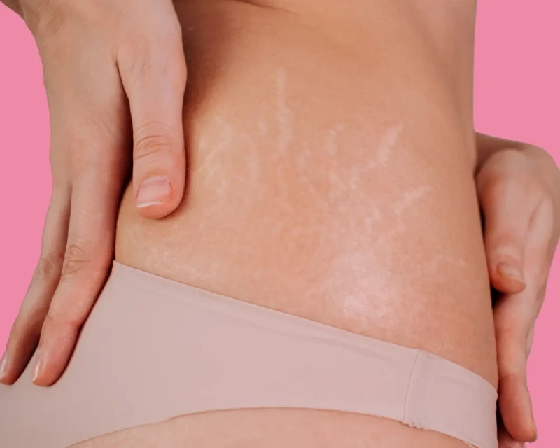 Кожа в полосочку: почему после беременности бывают растяжки и можно ли их уменьшить