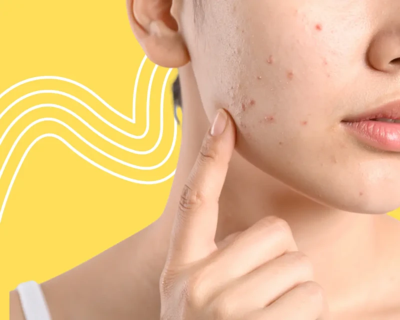 5 вопросов и ответов про «послеродовое акне»