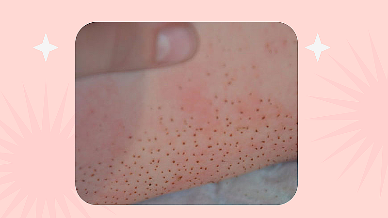 Щекотун у детей