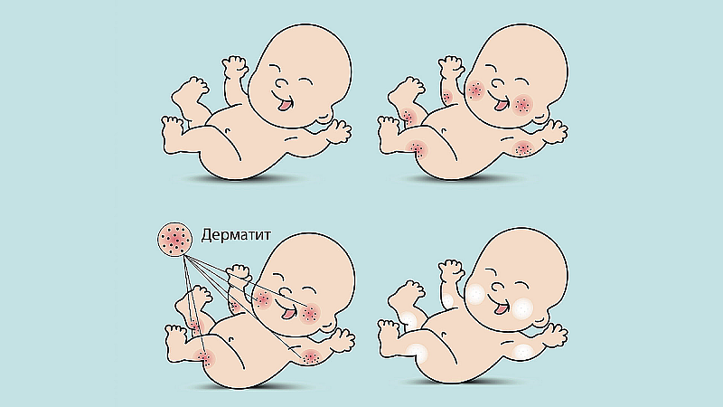 Пеленочный дерматит: как правильно помочь малышу и себе