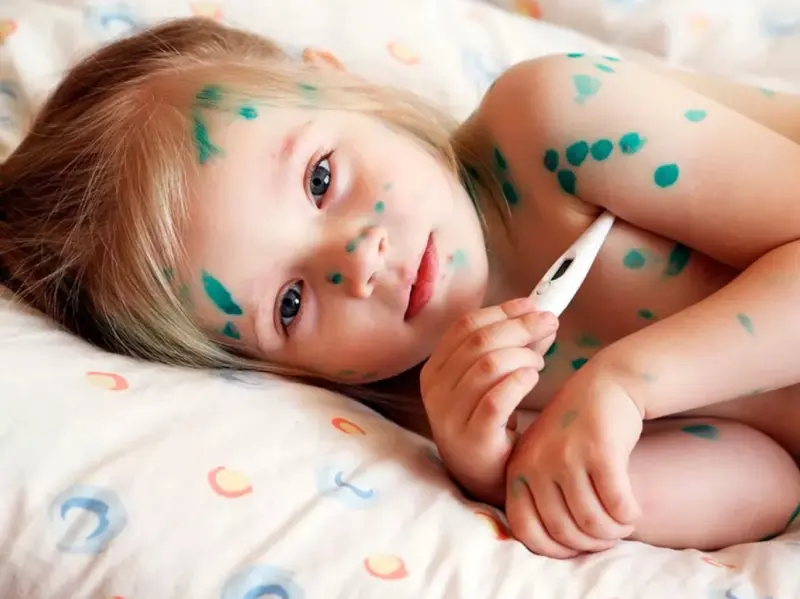 Росстат: в России резко выросли случаи ветрянки у детей