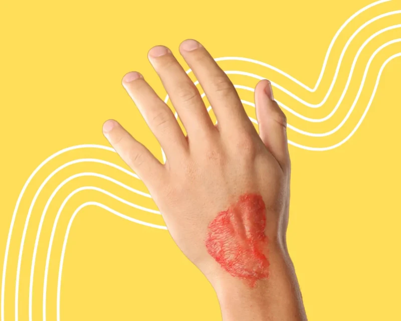 Это навсегда? Что делать, если у ребёнка остался след от ожога