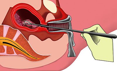 Хирургический аборт