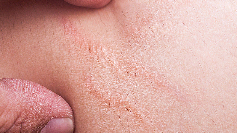 Целлюлит во время беременности