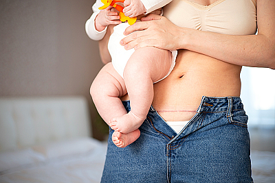 Восстановление после кесарева сечения: бережный уход за собой