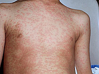 Корь – профилактика, признаки, лечение