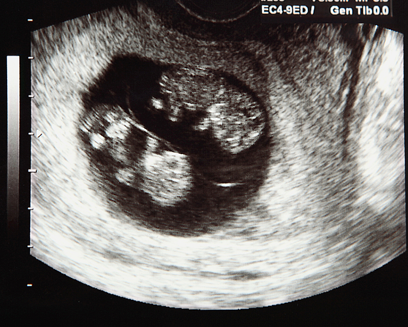 Беременность двойней: признаки, сроки, УЗИ и как проходят роды